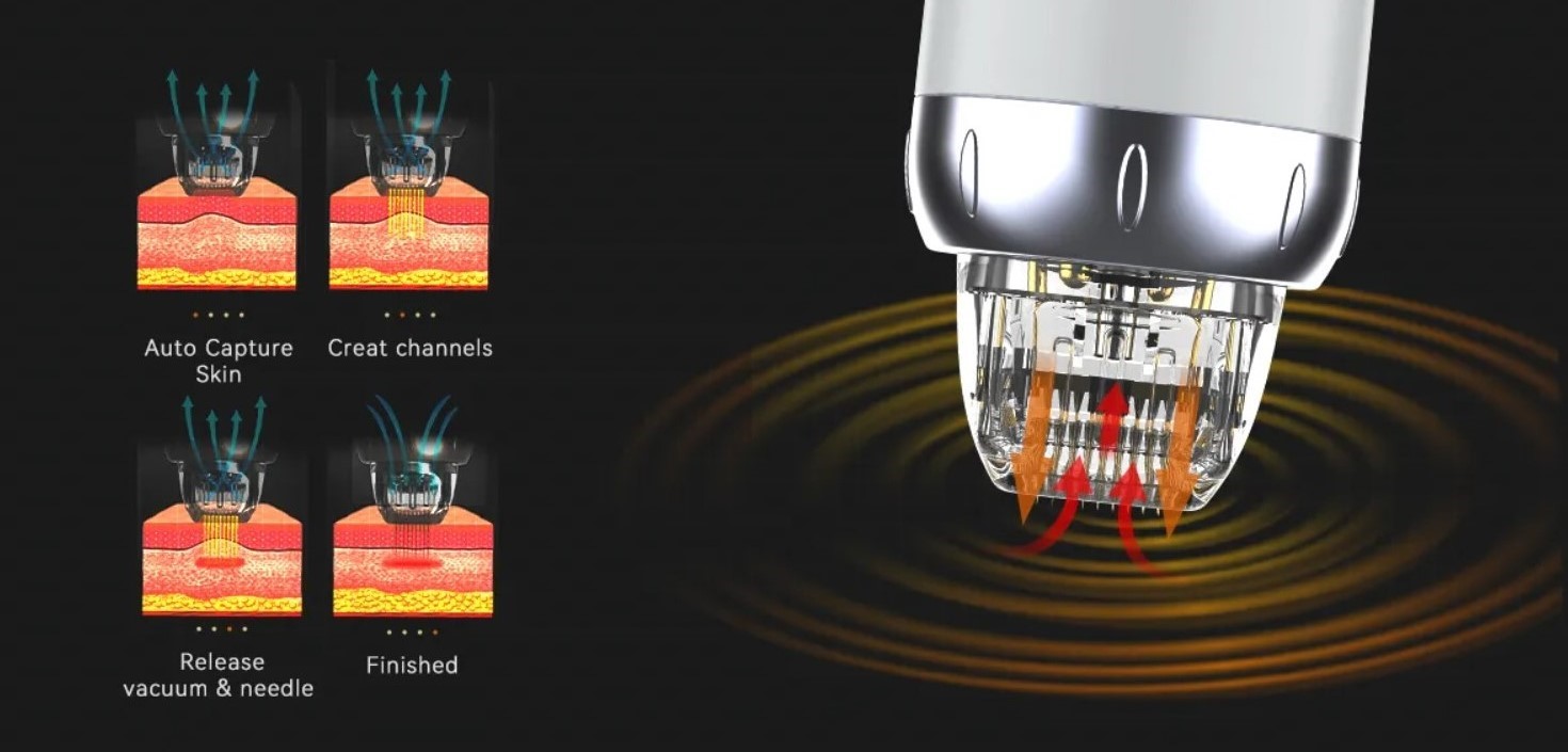 RF Microneedle Fractional Machine mit Vakuum – neueste Generation der fraktionierten MikronadelRF-Technologie 2 MHz – Bild 5