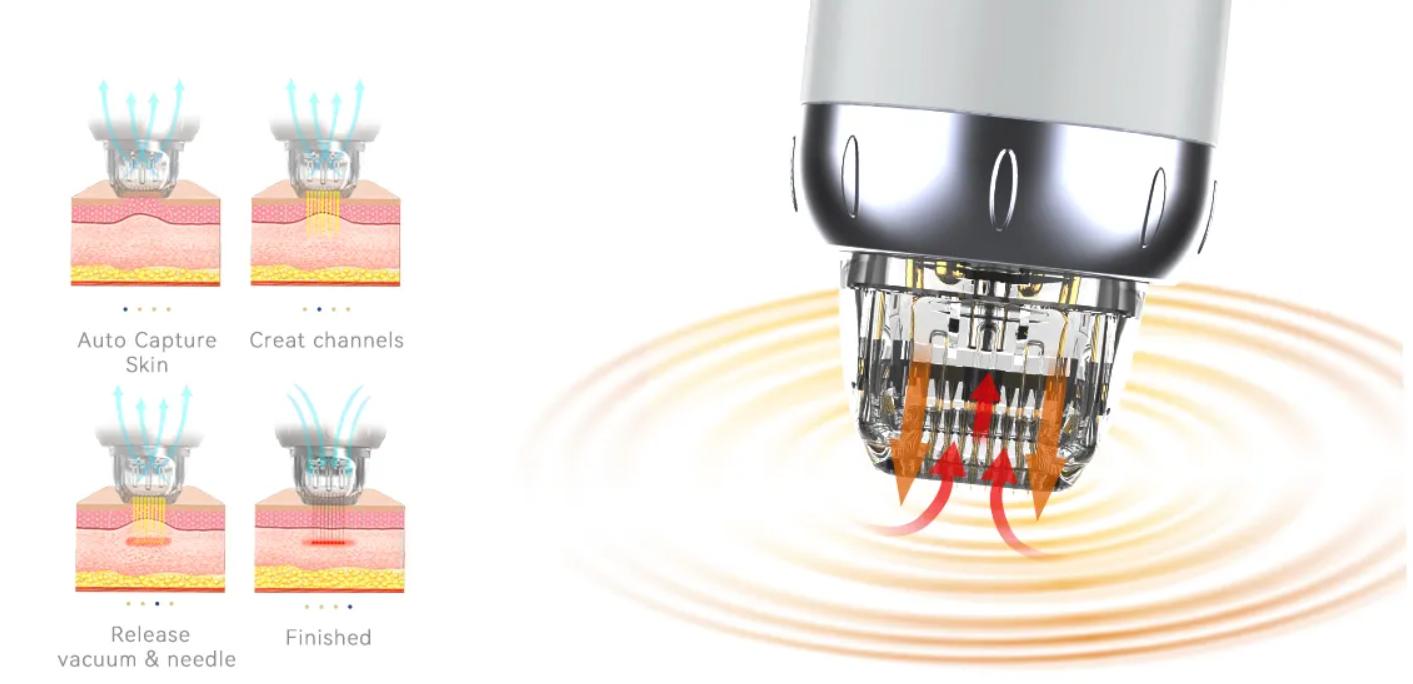 Handgriff mit vergoldeten Mikronadeln – Vorteil Vakuum RF Microneedling 3 microneedling-vakuum-system-anwendung Anwendung des Vorteil-Vakuum RF Microneedling Systems am Gesicht