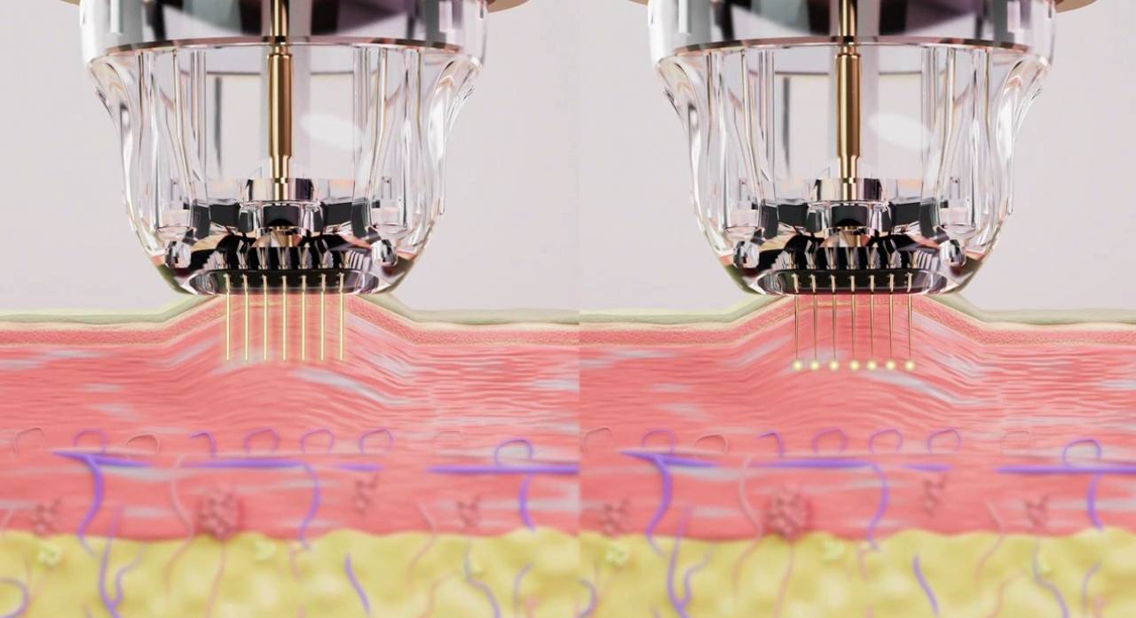 RF Microneedle fractional machine performing skin treatment cross-section illustration