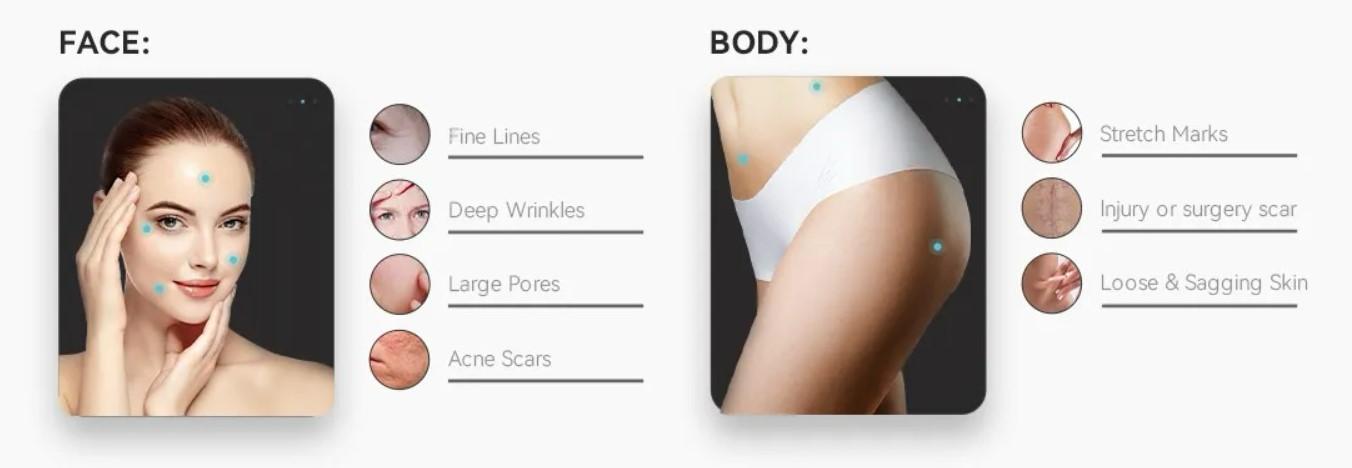 RF MICRONEEDLING GERÄT 2 MHz – Bild 4